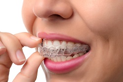 Photograph of someone removing their clear aligners, Cosmetic Dentistry, Chicago Loop, IL