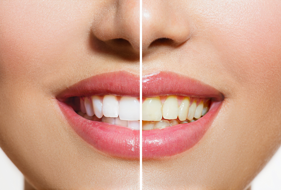 Teeth whitening before and after from Cosmetic Dentistry, Chicago Loop, IL